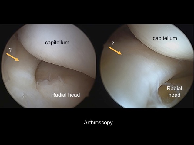 Figure 5 for case annular ligament of radius ( RID2048 )